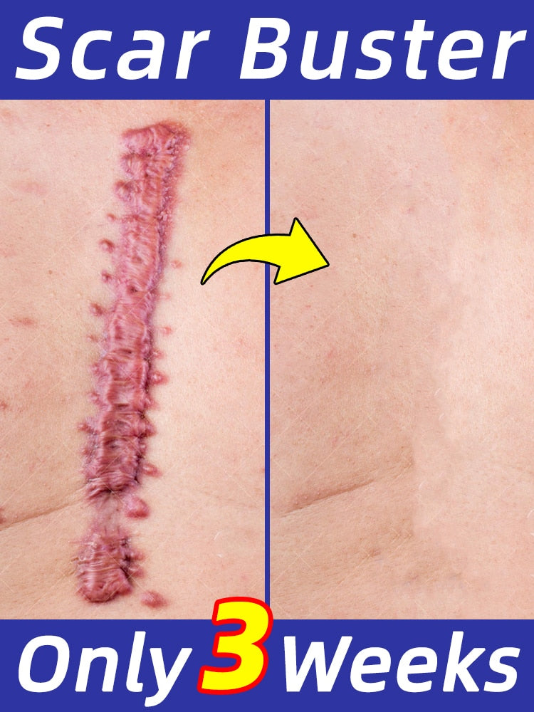 Scar Removal Cream Remove Keloid Surgical Burn Scald Caesarean Section Stretch Marks Scars
